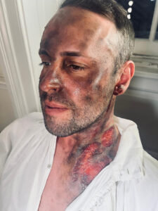 A man with facial makeup showing burn injuries.